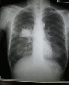 第三章 病例分析——肺癌