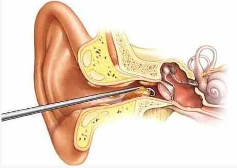 别总掏耳朵了 耳屎原来也很重要 很多人认为耳朵挖得越干净越好 耳朵