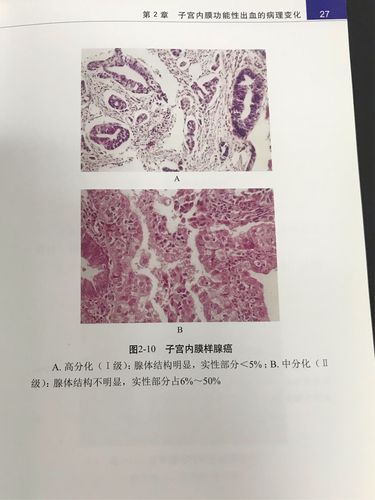 子宫内膜临床病理图鉴1/2