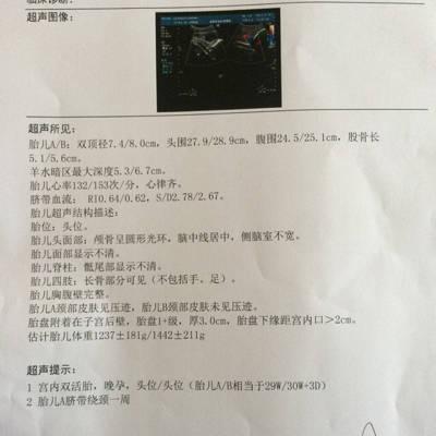 我是单绒双羊双胞胎,两个胎儿大小相差10天,根据彩超的结果来看,会不