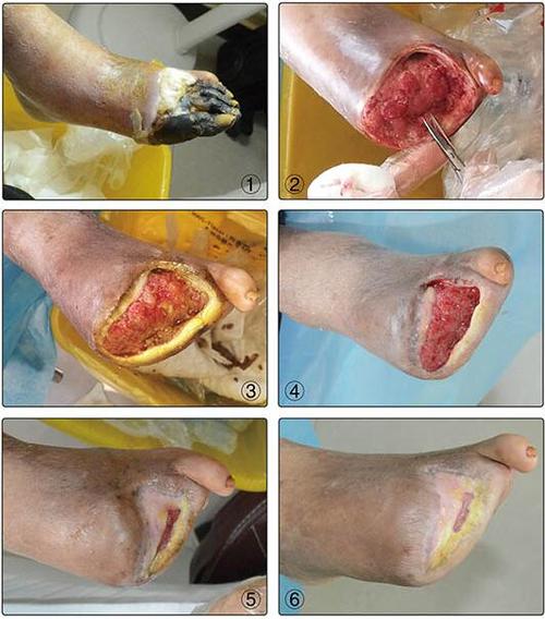 糖尿病足缺血性坏疽的中医保守治疗