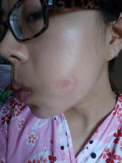 脸上皮肤长了一块藓一样的东西,指甲盖大小,一开始有点痒,现在不养了