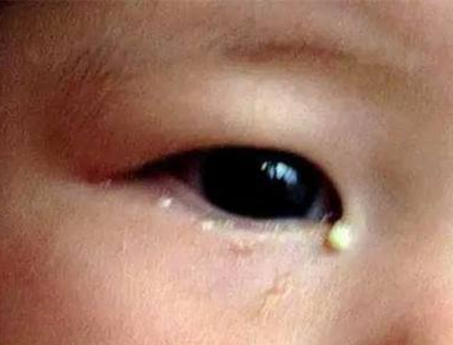 宝宝"眼屎"太多是咋回事?新手父母别忽视
