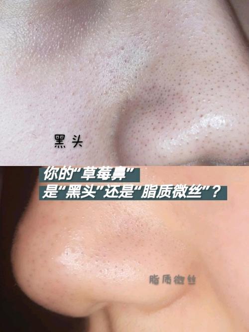 终结黑头#黑头粉刺7215只要鼻子上出现小黑点
