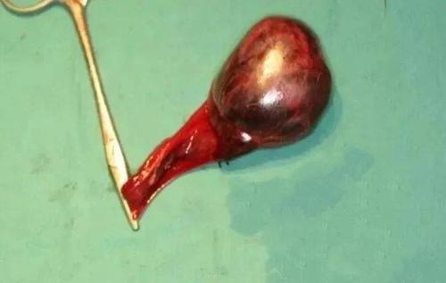 手术摘除的扭转的睾丸