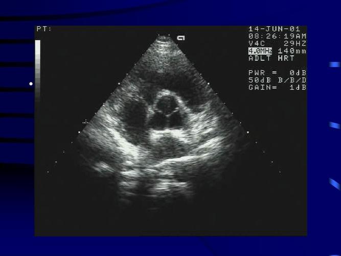 心脏解剖及正常超声心动图2008ppt