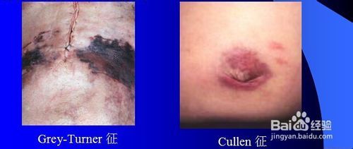 体征与病情严重程度相关    重症急性胰腺炎患者出现急性腹膜炎体征