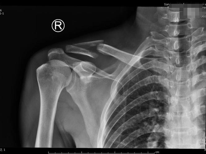 锁骨骨折微创治疗之mipo