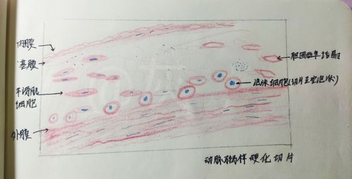 以下是一张风湿性心肌炎的切片,找出一个风湿小体画出,并画出枭眼细胞