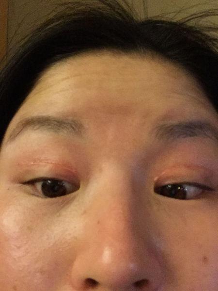 割双眼皮疤痕增生凸起怎么办?会下去吗?