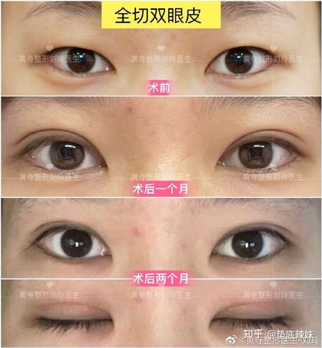 哪种双眼皮最好看双眼皮有几种