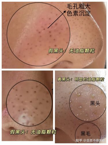 请问这个是黑头吗太严重了吧