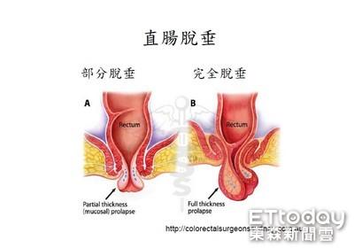脱肛是痔疮还是直肠脱垂? 别傻傻分不清!