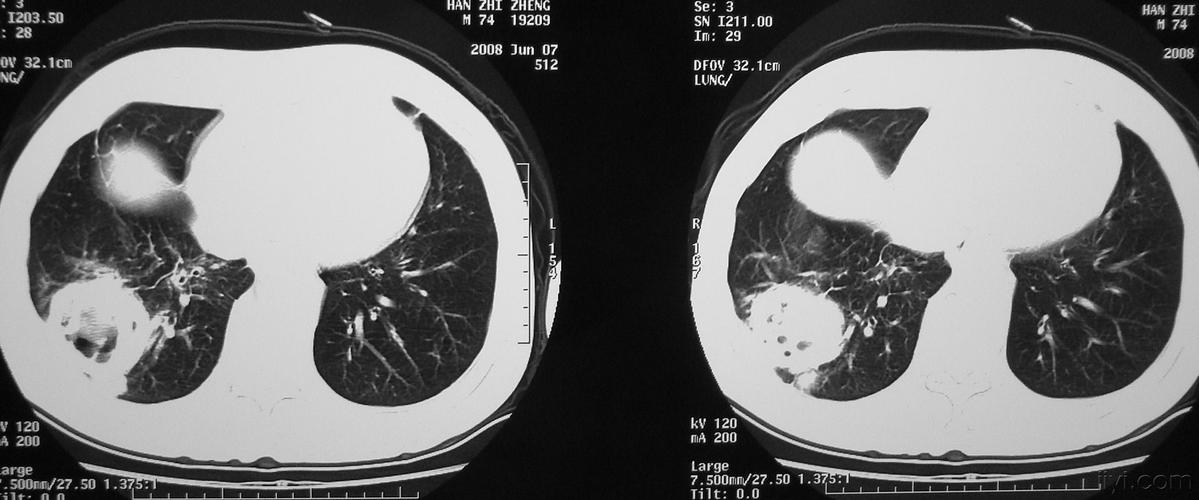 肺癌? - 医学影像学讨论版 - 爱爱医医学论坛