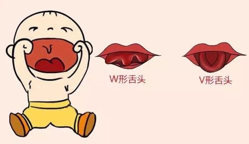 舌尖长成"w"形,宝爸宝妈千万要留意!