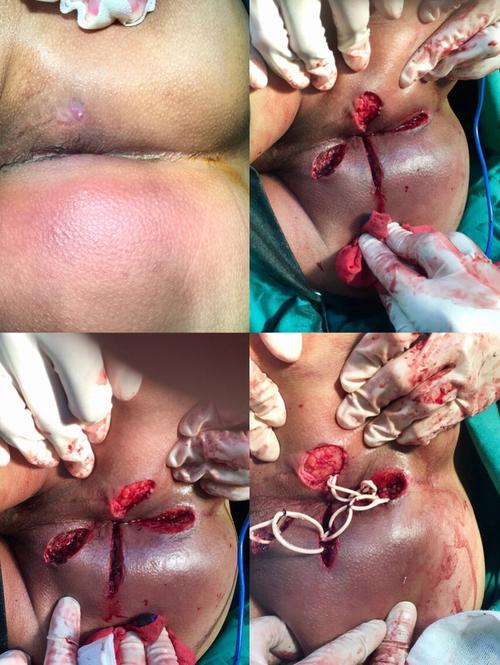 高位复杂性肛瘘合并坐骨直肠窝脓肿