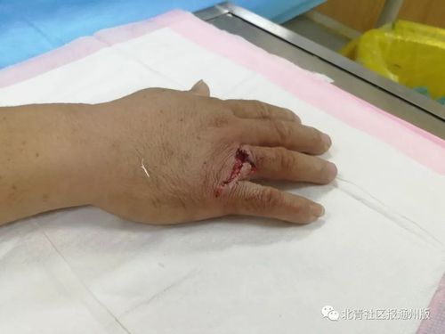 被猴咬,被仓鼠咬.潞河狂犬病门诊里多得是你想不
