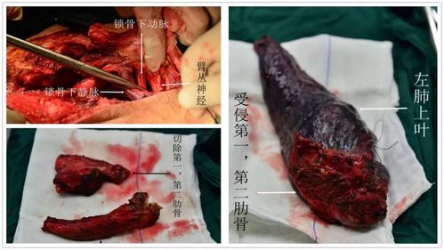 【手术故事】胸外科四病区成功完成我院首例肺上沟癌