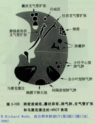 肺大泡肺气肿肺气囊囊肿空洞ct如何鉴别