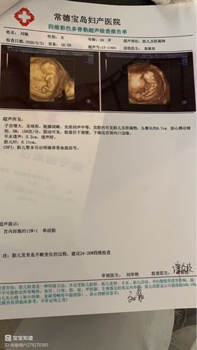 怀孕12周 nt照片 宝宝爬着睡