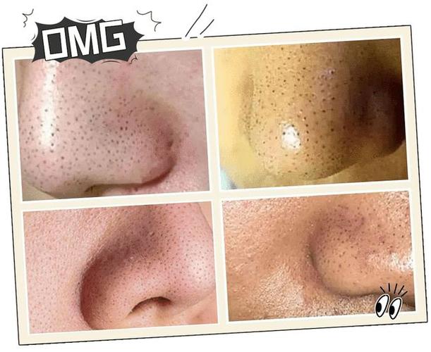 去黑头有100招到底哪招适合你