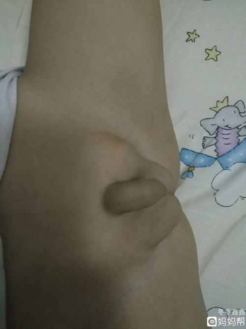 宝宝弟弟旁边鼓了一个包