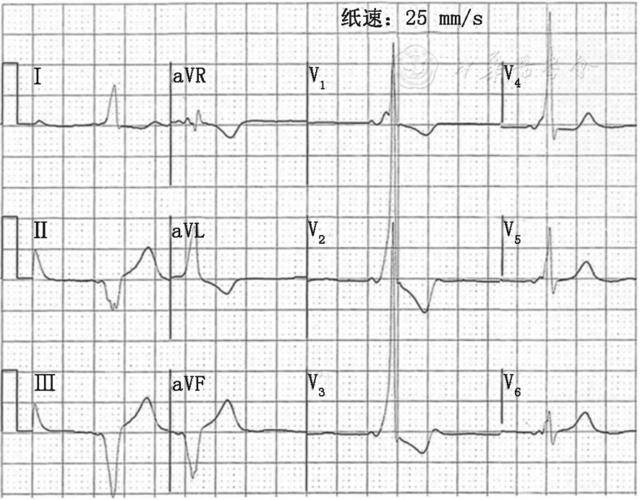 a型预激综合征心电图表现