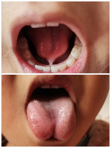 宝妈必读之舌系带过短—连舌