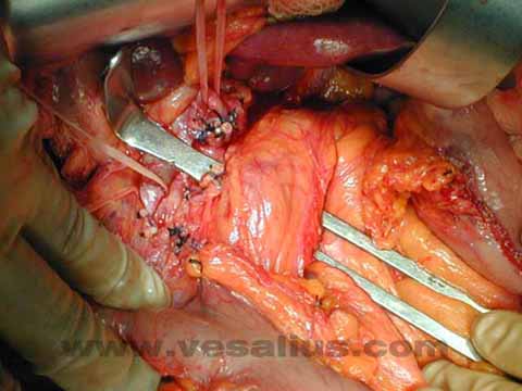 胰十二指肠切除术