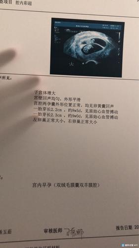 [试管婴儿]孕囊形状是龙凤胎还是两个儿子