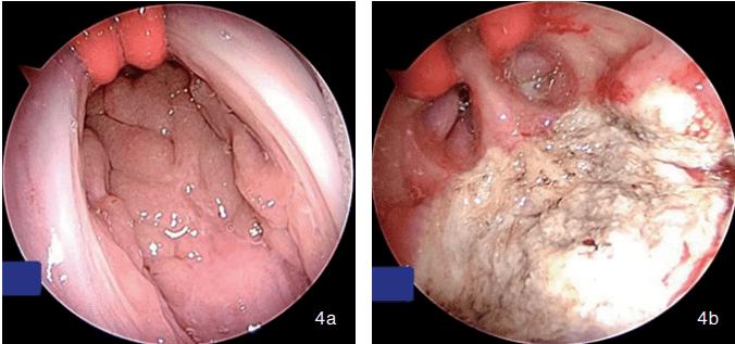a为腺样体手术术前照,可见腺样体完全阻塞后鼻孔;b为腺样体手术术