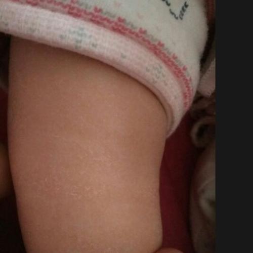 宝宝 宝宝3个月了,皮肤上像是干燥脱皮一样,腿上特别多,是怎么回事啊?