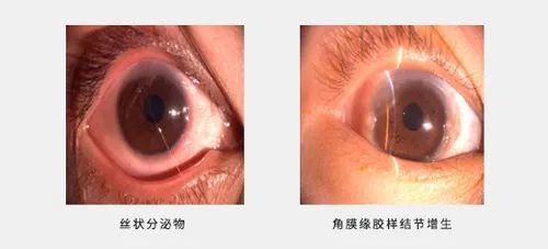 一到春天眼睛奇痒无比?当心过敏性结膜炎!