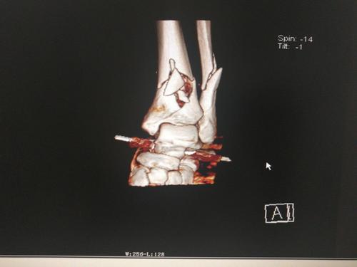 左胫腓骨开放性粉碎性骨折