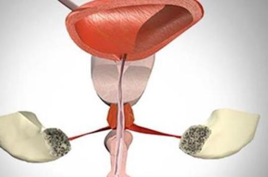 膀胱炎的症状有哪些