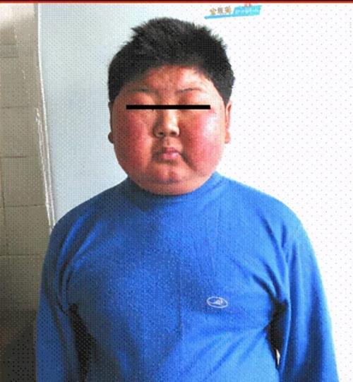 向心性肥胖,满月脸,水牛背文子4.如何治疗垂体瘤?1.