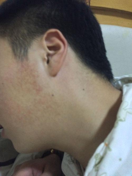 脸上有这种红色的很粗糙,有好多年了,脸特别容易红!求助!