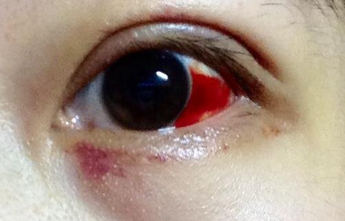 白眼球"出血"即球结膜下血管破裂或其渗透性增加引起的结膜下出血.