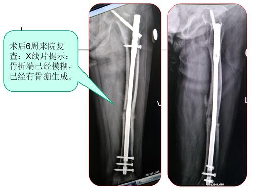 【创伤篇】 闭合复位髓内钉固定治疗股骨干骨折