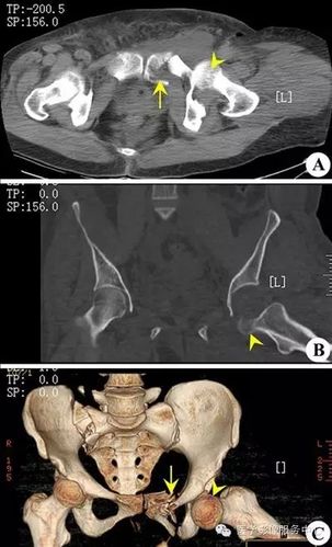 v【影像表现】:x线头颅侧位(a)及ct横断面骨窗(b)可见多个圆形,虫蚀