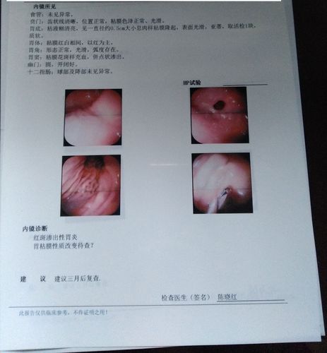 5息肉,还做了病理检查是复合胃底腺性息肉,到底