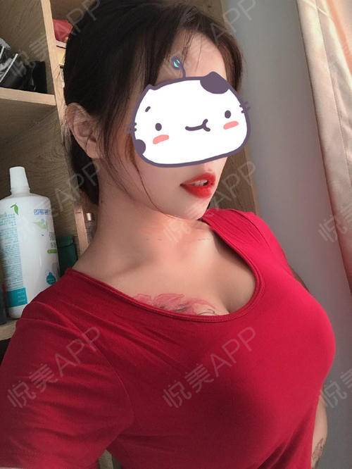 隆胸手术做的很成功,首先胸型很好看,摸起来柔软很有弹性,胸器很挺