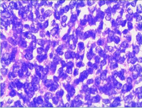 提示光镜下肿瘤细胞形态如图所示.