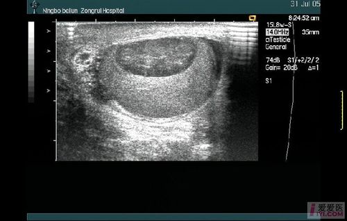 【原创】左侧睾丸炎性肿块