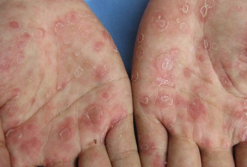 女性专题 正文   在梅毒患者刚恢复性生活的第一年,性交时宜用避孕套.