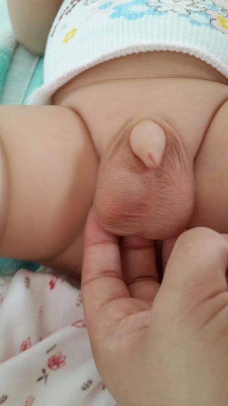 两个月宝宝,睾丸一大一小,每天相差的不是特别大,但今天突然更大了,是