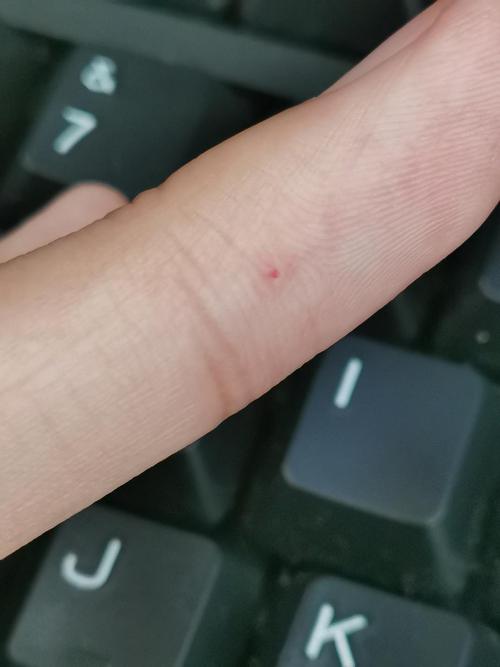 手上红点是什么