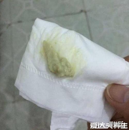 霉菌用手抠出来的图片呈豆腐渣样分泌物手抠会加重炎症