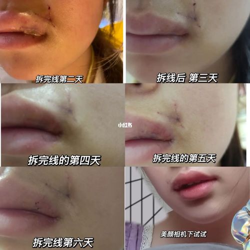 真实切痣日记 ① 切痣需谨慎 姐妹速来_祛痣_疤痕_日记_生长因子_祛疤