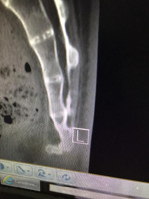 十七年前从高处跌下,尾骨严重错位,最下面一节前倾呈90度,第二节严重